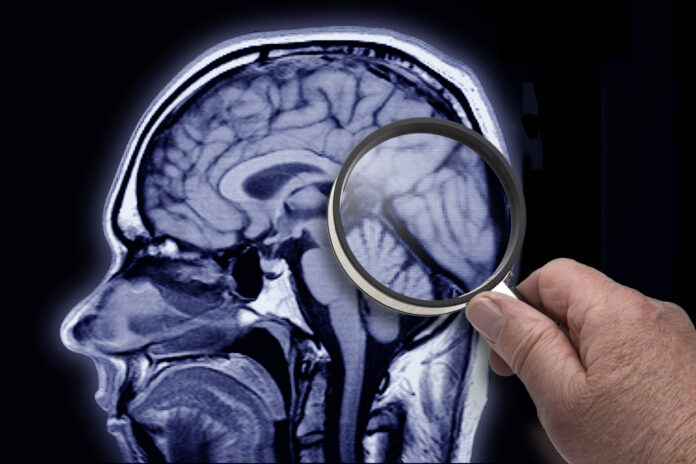 A mayor educación, más rápido el deterioro cognitivo por Alzheimer