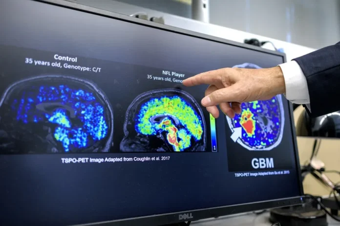 Unos científicos latinos en EE.UU. hallan un biomarcador que podría detectar temprano el Alzheimer