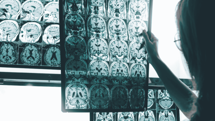 Nuevo índice mide el avance del Alzheimer cerebral