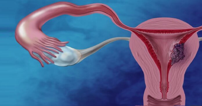 La salud de la mujer frente al cáncer ginecológico y su impacto familiar en RD